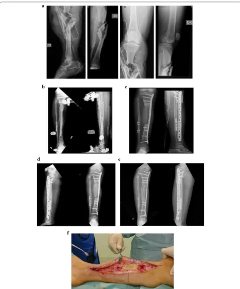 Fig. 2 Male 49-year-old patient with grade III open fracture of the right leg (a). The fracture was treated with EF and placement of a cement spacer into the bone defect