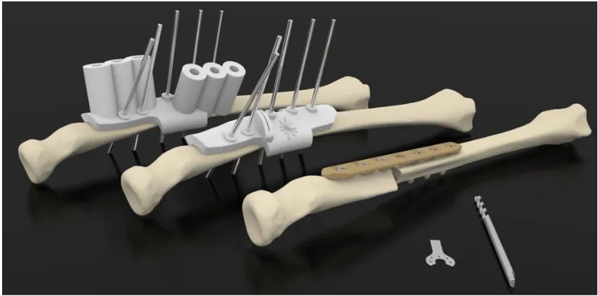 Figure 2.2: Drilling guide for fixing plate attached to model of bone1. 