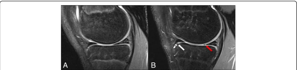 Fig. 1 Sagittal PD FS images showing the medial compartment of the femorotibial joint of an adolescent male volleyball player at baseline2- year follow-up a and b