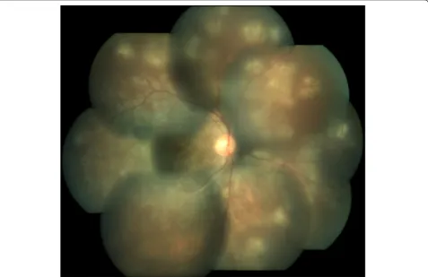 Figure 1 Active multifocal serpiginoid choroiditis. Montage picture of the right eye showing multiple discrete areas of active choroiditisamidst areas of healed chorioretinal atrophic scars with grade 2 vitritis at presentation.