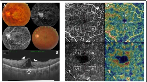 Fig. 5 Left eye of a 51-year old male patient with ischemic type of CRVO. a. Color fundus photo and FFA shows the typical blood andthunder appearance of CRVO, with marked optic disc swelling and hyperemia along with macular edema