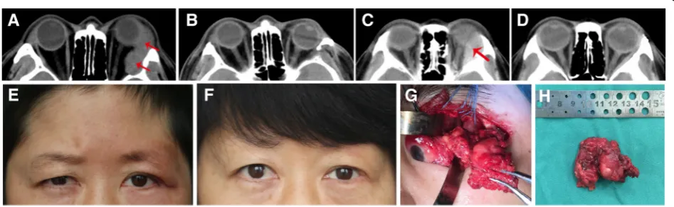 Fig. 1 CT scan of Case 9, who had adenoid cystic carcinoma of the lacrimal gland, and axial computed tomographic scan after surgical resection(a, b)