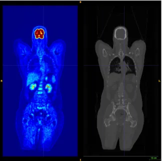 Figure 3.1: Left: PET image. Intensity levels (shown in jet color spectrum) indicate the level of18F-FDG uptake in tissue