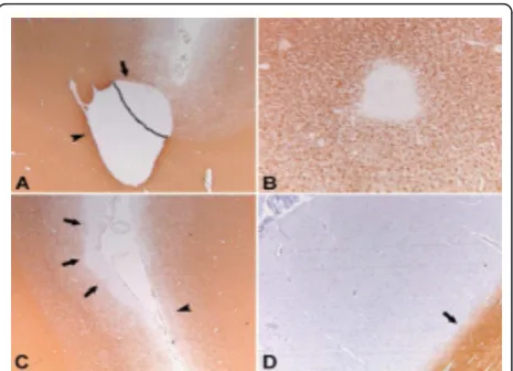 Figure 2 Pathological classification system of GM lesions in MSGM lesion classification system as proposed by Bo et al,