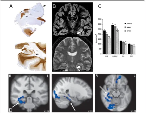 Figure 4 Non-neocortical GM damage: the hippocampus. A) Extensive hippocampal demyelination observed in post-mortem material.Reproduced from Geurts et al