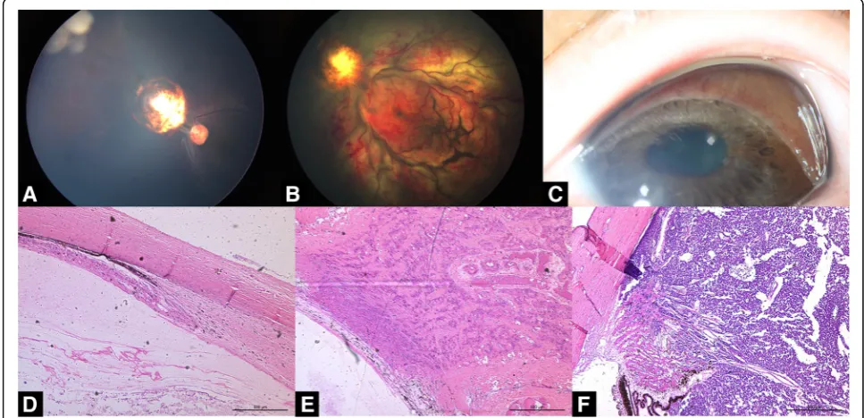 Fig. 3 Corneal edema and phthisis. Refractory diffuse vitreous seeds in unilateral retinoblastoma after six cycles of intra-arterial chemotherapy