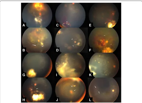 Fig. 5 Vascular occlusion. 6 cases with vascular occlusion before and after IVM have been shown in Fig.pupillary synechiae