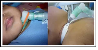 FIGURE 1Fit of standard vs extended-style tracheostomytube in ventilated infant (Arcadia shown)