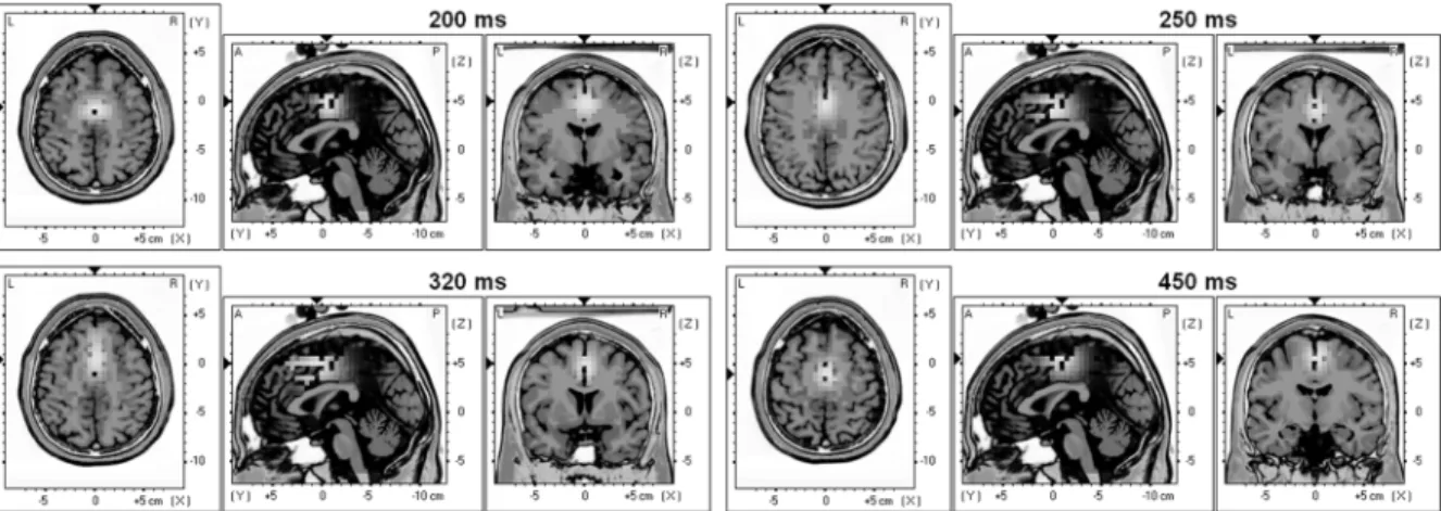 Fig. 4. Talairach slices of localized activity for the grand average of the five subjects for the first day of recording at the occurrence of the four peaks described in Section III-A