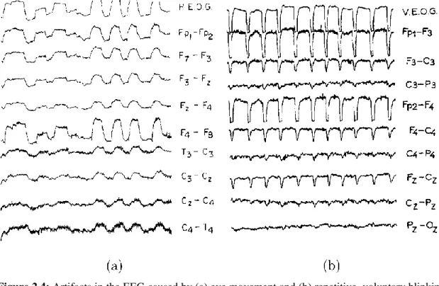 Figure 2.4: Artifacts in the EEG caused by (a) eye movement and (b) repetitive, voluntary blinking