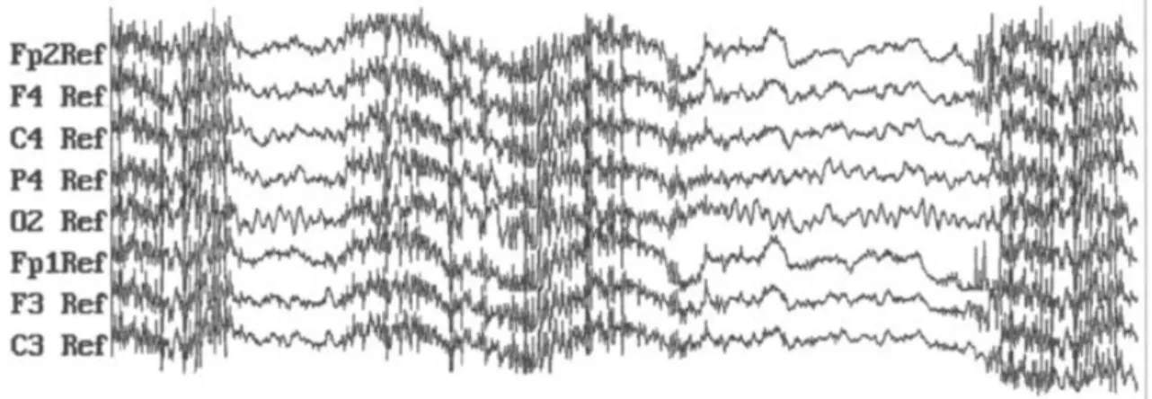 Figure  2.5:  A  5-s,  multichannel  EEG  recording  contaminated  with  intermittent  episodes  of  EMG  artifacts