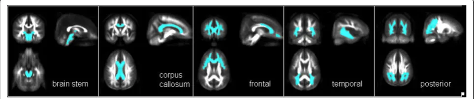 Figure 1 Example of typical macrostructural WM alterations onthe contralateral side. Similarly, uni- or bilaterally highly significant FAreductions were found in patients with macrostrucural lesions, asconventional structural MRI (A) and the correspondent 
