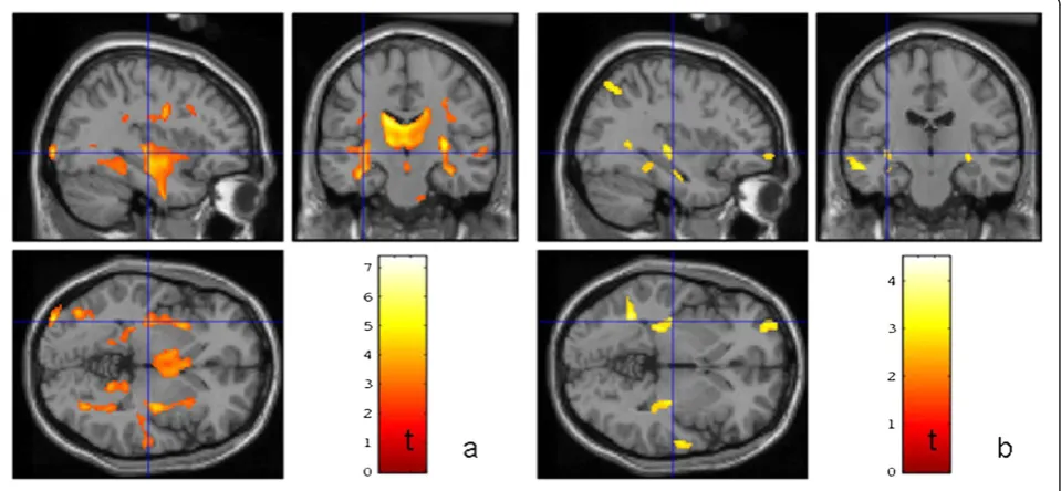 Figure 3 FA values per group. FA x 1000 of all priori defined ROIs for the healthy controls, the patients with normal conventional MRI and thepatients with mild alterations on conventional MRI with means, standard errors and standard deviations.