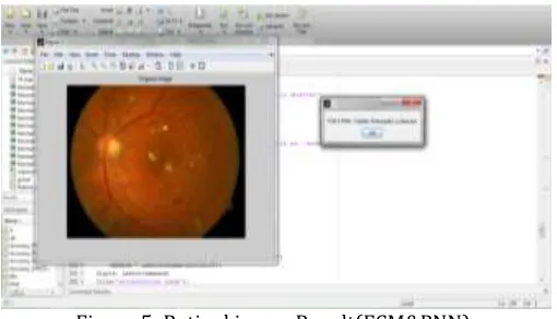 Figure 3:Retinal image result(FCM &SVM)  