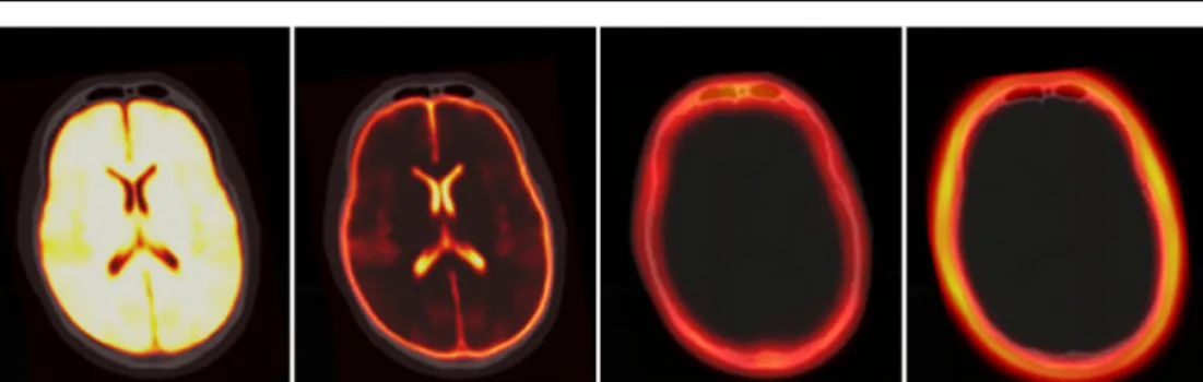 Figure 4. False colour overlay of registered atlas on patient CT; layers from left to right: brain, CSF, skull, scalp.