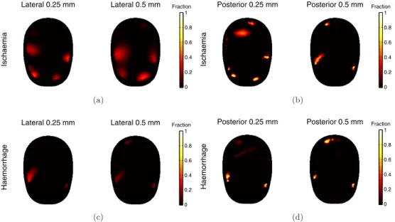 Figure 5. Erroneous electrode positions results, images reconstructed with errors of 0.25 mm and 0.5 mm standard deviation added to the electrode position: (a) lateral ischaemic stroke, (b) posterior ischaemic stroke, (c) lateral haemorrhagic stroke, (d) p