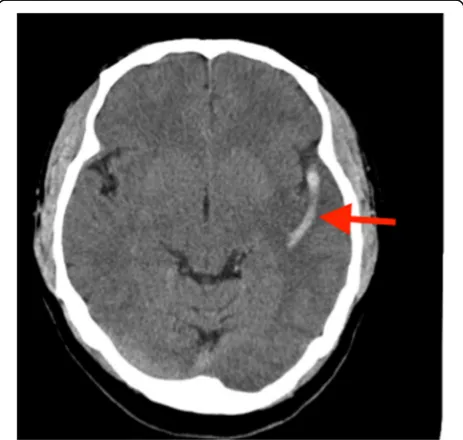 Fig. 1 A brain computed tomography image showing the thrombusin the left middle cerebral artery (arrow)