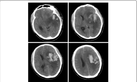 Fig. 2 Brain computed tomography images showing left temporal lobe insular lobe infarction and haemorrhagic transformation