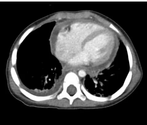 FIGURE 1CT scan of the chest demonstrating moderate pericardial effusion, thickening of the pericardium,and bilateral small pleural effusions.