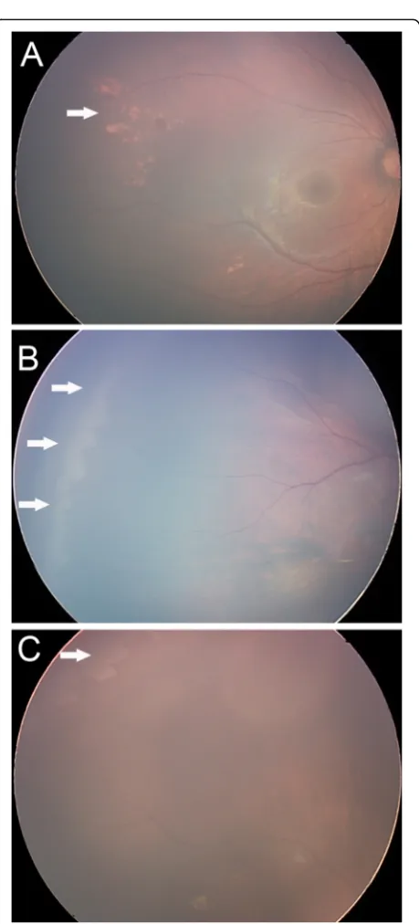 Fig. 3 Retinal pigmentation was found in 3.3% of all screenedinfants (pointing by white arrow)