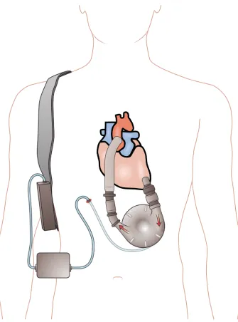 Figure 1. The left ventricular assist device (LVAD).  Ventricular Assist Device. Unmodified from Madhero88 (https://en.wikipedia.org/wiki/Ventricular_assist_device#/media/File:Ventricular_assist_device.png) , reproduced under the conditions Creative Common