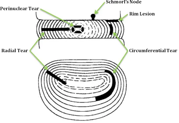 Figure 3: Representative annular and intervertebral disc defects. (Vernon-Roberts, Moore et al