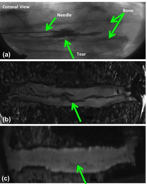 Figure 15: Volume renderings of tears: (A-B) Radial and (C) Perinuclear/Radial – coronal views; (D-E) Circumferential – axial and coronal views of the same specimen
