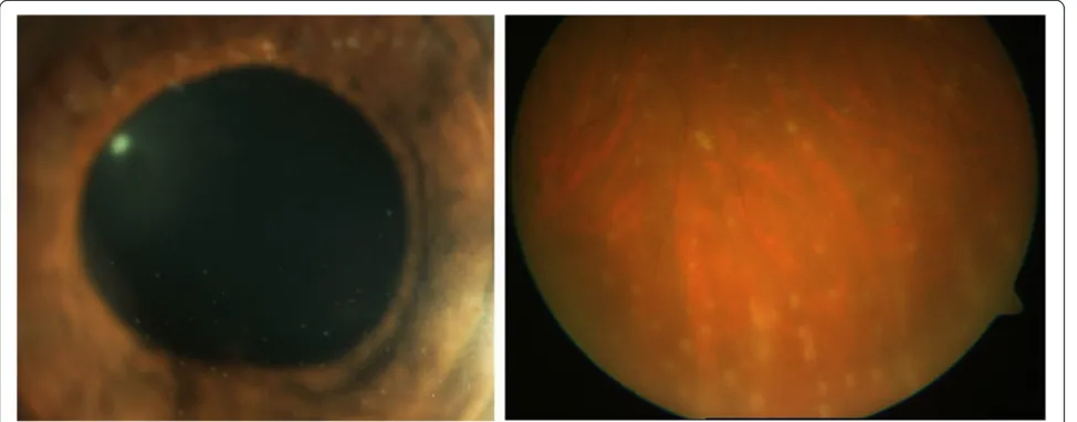 Figure 2 Slit-lamp (left) and fundus (right) photographs of a patient with etanercept-induced sarcoid-like uveitis