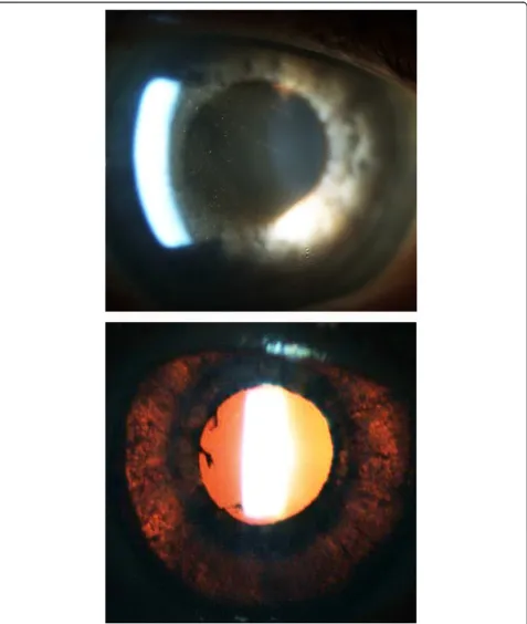 Figure 3 Slit-lamp photographs of the anterior chamber in a patient with moxifloxacin-associated uveitis