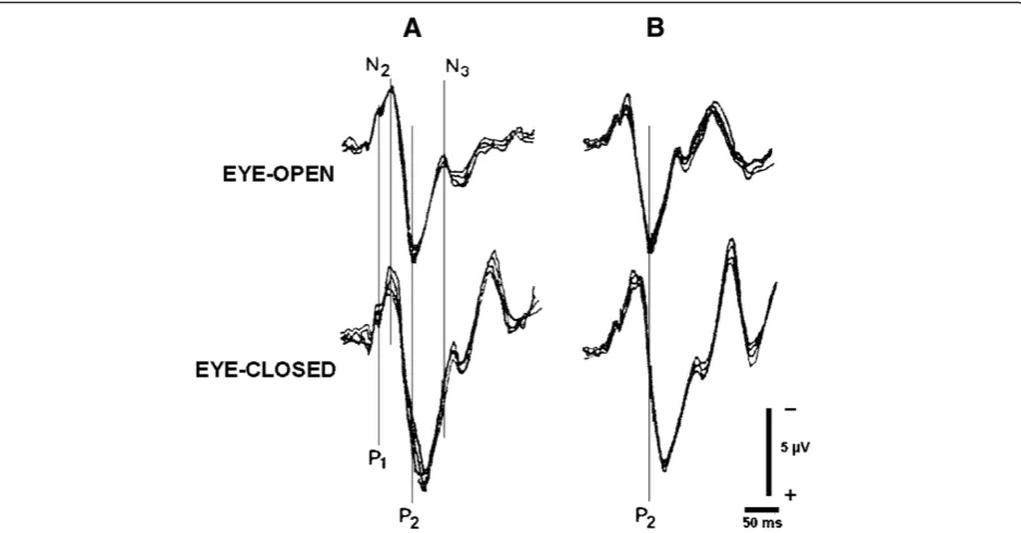 Figure 1 F-VEPs recorded in an AD-AL patient from left (A) and right (B) eye were averaged from 4 separate blocks of 64 trials