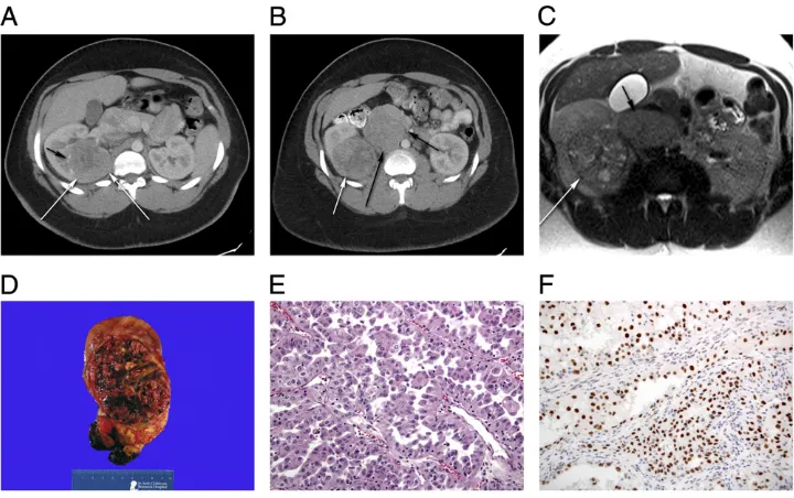 FIGURE 6Xp11.2 translocation RCC. A, Axial contrast-enhanced CT of the abdomen reveals a heterogeneous mass in the right kidney (white arrows)