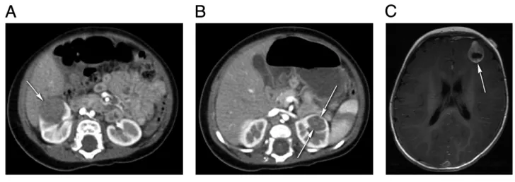 FIGURE 7Rhabdoid tumor. A, Axial contrast-enhanced CT of the abdomen demonstrates a hypodense solid mass in the right kidney (white arrow)