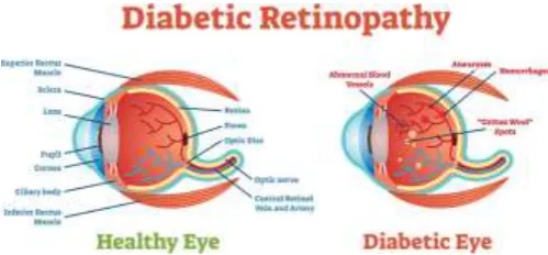 Fig -1: Comparison of Healthy eye and Diabetic eye 