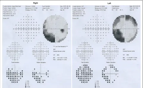Fig. 5 VEP shows reduced bilateral P100 amplitudes, although P100 latencies are normal in both eyes