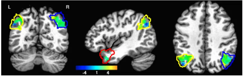 Figure 2: Task-responsive voxel activity (task vs. ITI fixation baseline) in left ATL (red), 