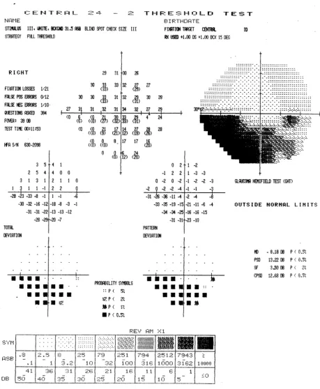 Figure 3tioninferior arcuate scotoma, and the computer algorithm applied the same classification