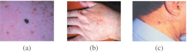 Fig. 1: Lentigo simplex (a), Solar lentigo (b) and Lentigo maligna (c).
