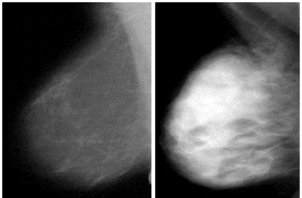 Figure  1.1  Mammograms  depicting  low  (left)  and  high  (right)  density. Images from the International  Breast Cancer Intervention Study-I