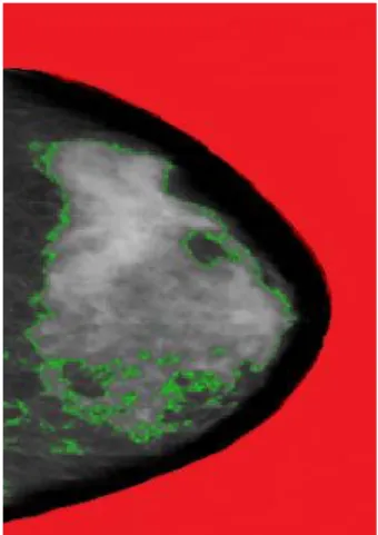 Figure  1.2  Cumulus  thresholds  (23)  applied  to  a  mammogram.  Image  from  the  International  Breast  Cancer Intervention Study-I