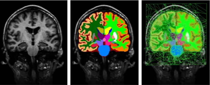 Fig. 1. Left: T1-weighted scan from the training data. Center: corresponding manual segmentation