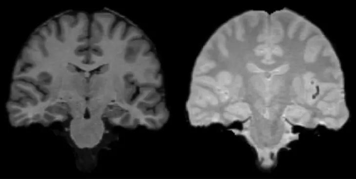Fig. 2. On the left an example slice from the intra-scanner dataset and on the right a corresponding manual segmentation.