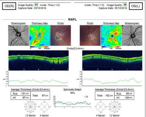 Fig. 2 Optic disc OCT scan detailing thinning of the superior retinal nerve-fibre layer of the left eye