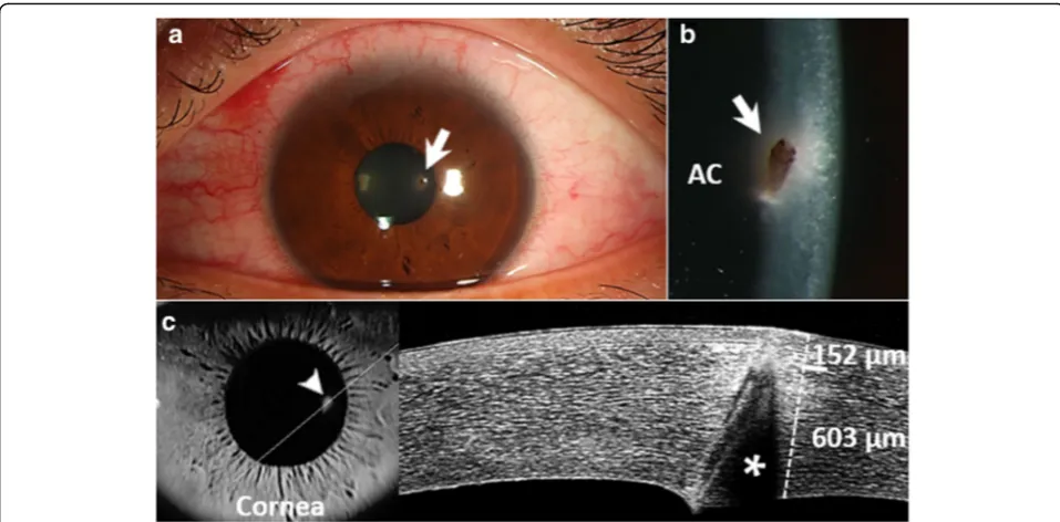 Fig. 1 a Slit-lamp examination demonstrated a chestnut embedded in the corneal stroma (arrow)