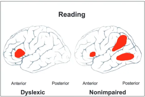 Figure 3. Schematic of brain activation maps in nonimpaired and dyslexic readers engaged in phonologic processing during the pseudoword rhyming test