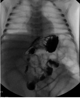 FiGuRe 1Abdominal radiograph showing distended loops of bowel with a paucity of gas overlying the rectum.