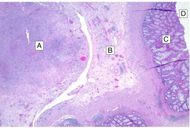 FiGuRe 3Barium enema showing normal caliber colon 