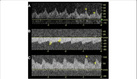 Fig. 3 CT-angiography demonstrating the patency of the by-pass graft.CT-angiography after EC-IC bypass shows left craniotomy defect withpronounced distal MCA flow from the left superior temporalartery (arrow)