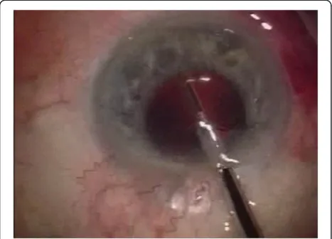 Figure 1 Under endoscopic guidance, ten laser spots wereapplied into the trabecular meshwork spread over an area of90°