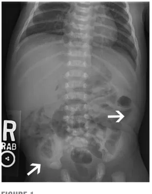 FiGure 1Abdominal radiograph obtained at the time of presentation with concerns of pneumatosis in the upper left and lower right quadrants (arrows).
