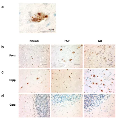 Figure 2.1 pPERK is activated in PSP, AD, and normal brain. a. Example of a cell with pPERK immunoreactive puncta in the pons of a PSP case